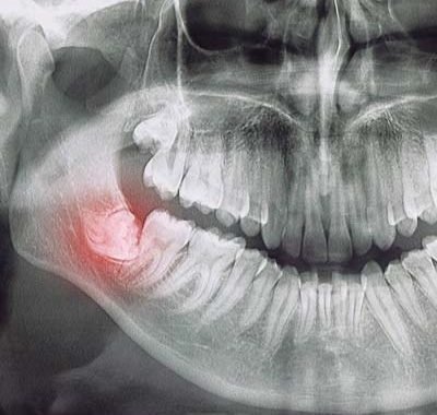 Wisdom Teeth removal Columbus