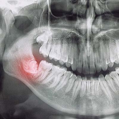 Wisdom Teeth removal Columbus