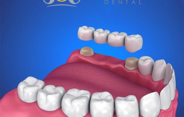 Dental Implant