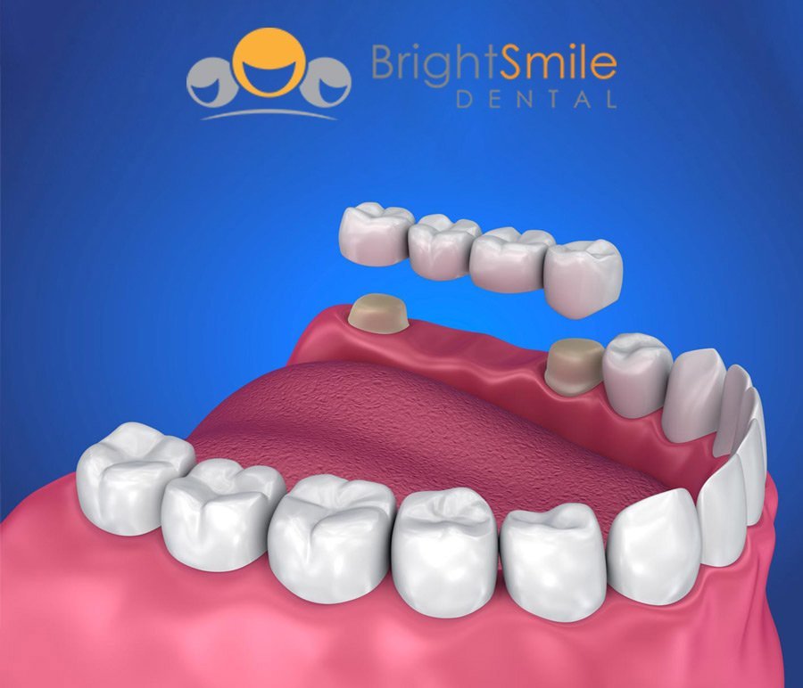 Dental Implant