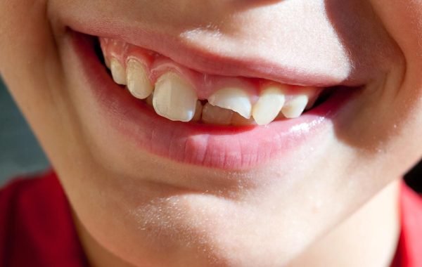 how-to-fix-a-broken-tooth-columbus