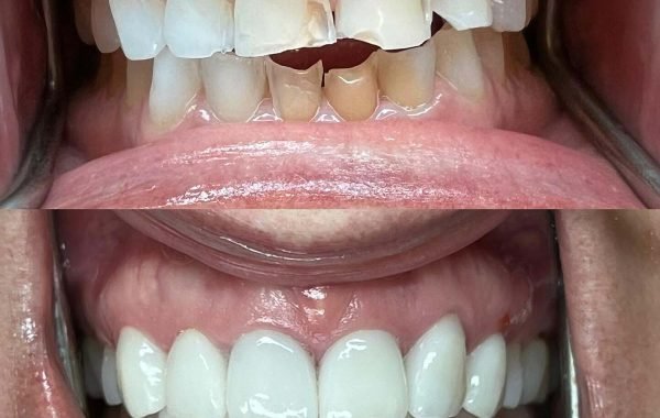 smile-makeover-columbus-ohio