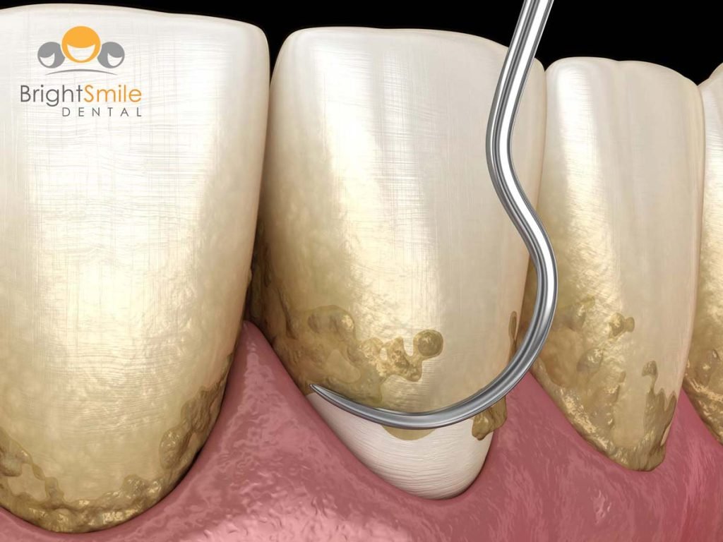 deep-cleaning-teeth-columbus