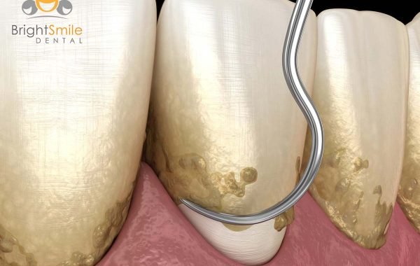 deep-cleaning-teeth-columbus