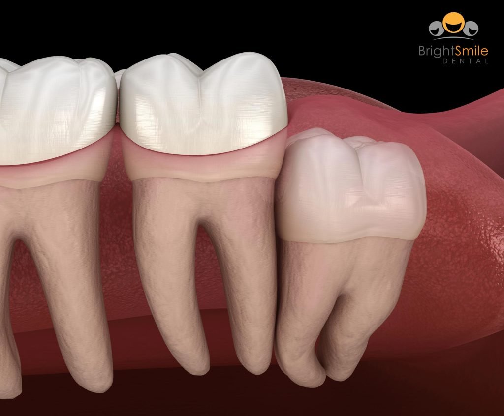 wisdom-tooth-removal-in-columbus
