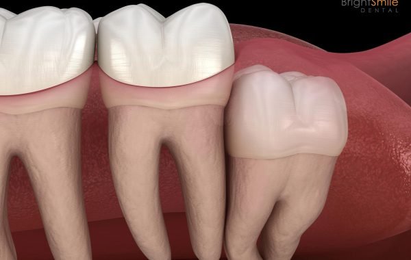 wisdom-tooth-removal-in-columbus