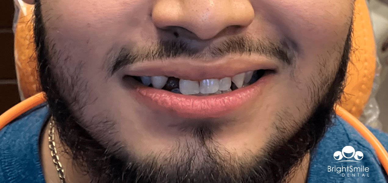oral-surgery-before-and-after-1