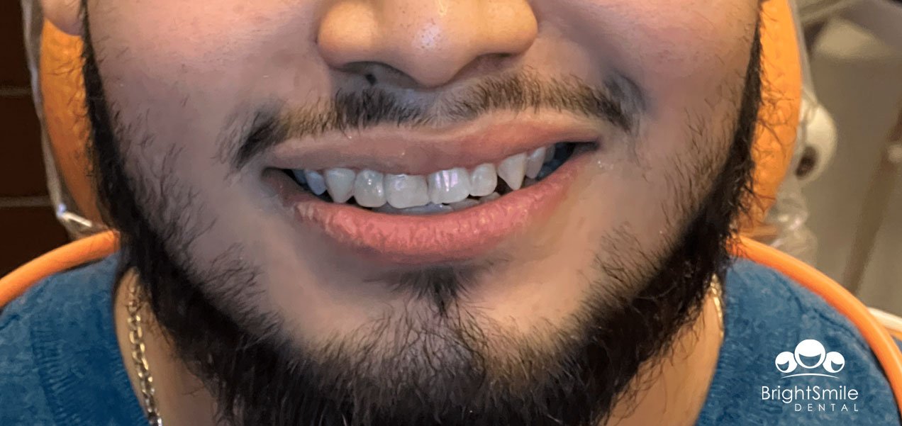 oral-surgery-before-and-after-2