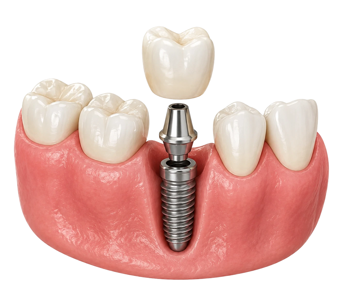 dental-implants-powell-ohio