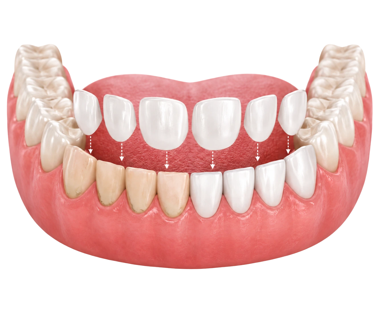 veneers-powell-ohio